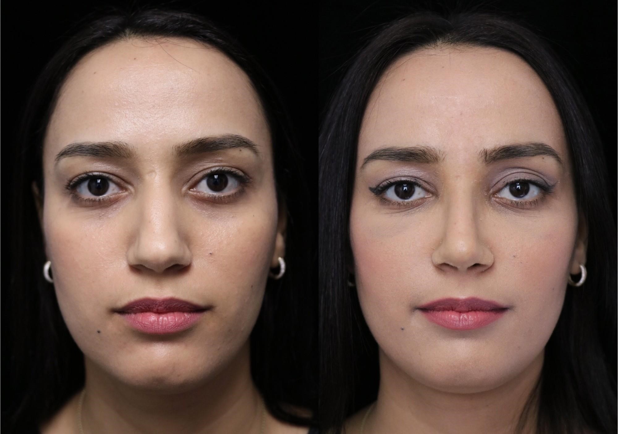 closed rhinoplasty