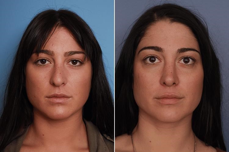 closed rhinoplasty